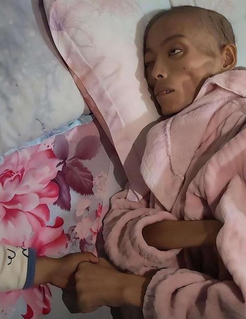 28岁女歌手患美人病;28岁女歌手患美人病死亡